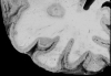 Laminar necrosis of cerebral ribbon secondary to global cerebral hypoperfusion